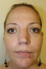 Vampire Facial 4 - Before Treatment
